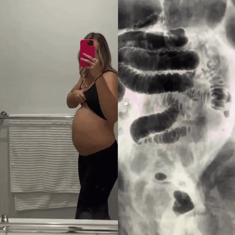 Bloating and backup, before